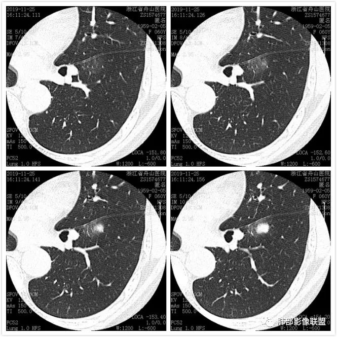 【病例】肺腺癌1例CT影像讨论
