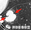 【病例】肺腺癌1例CT影像讨论