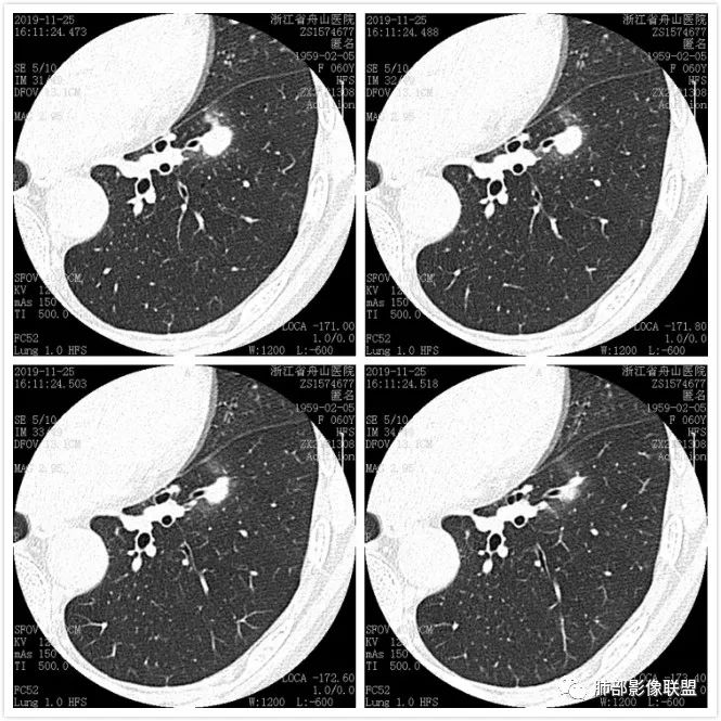 【病例】肺腺癌1例CT影像讨论
