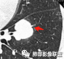 【病例】肺腺癌1例CT影像讨论
