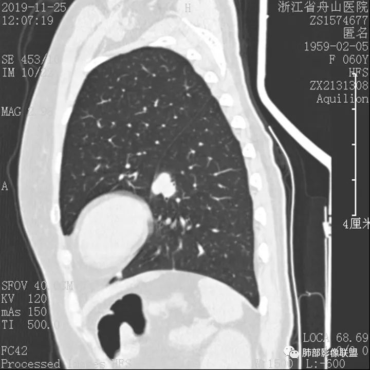 【病例】肺腺癌1例CT影像讨论