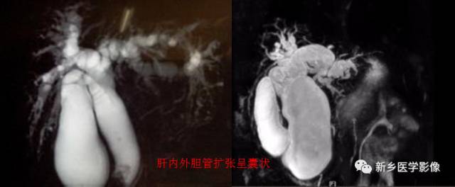 胆管常见的9种疾病
