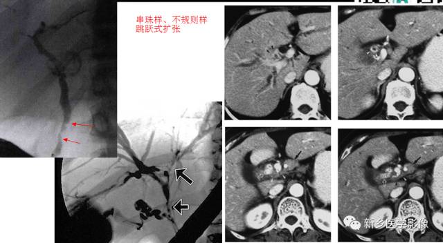 胆管常见的9种疾病