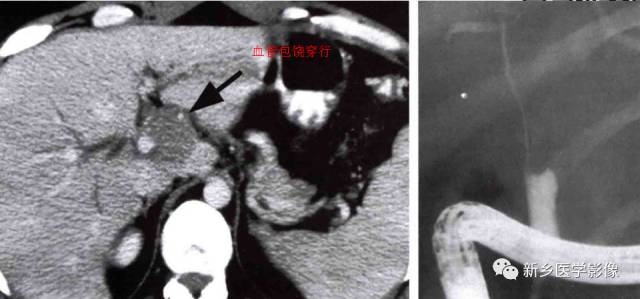 胆管常见的9种疾病