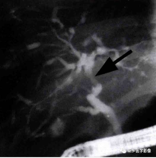 胆管常见的9种疾病