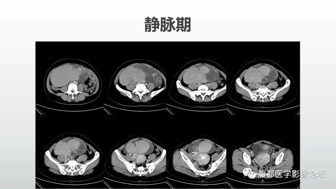 【病例】卵巢粘液性囊腺癌1例CT影像