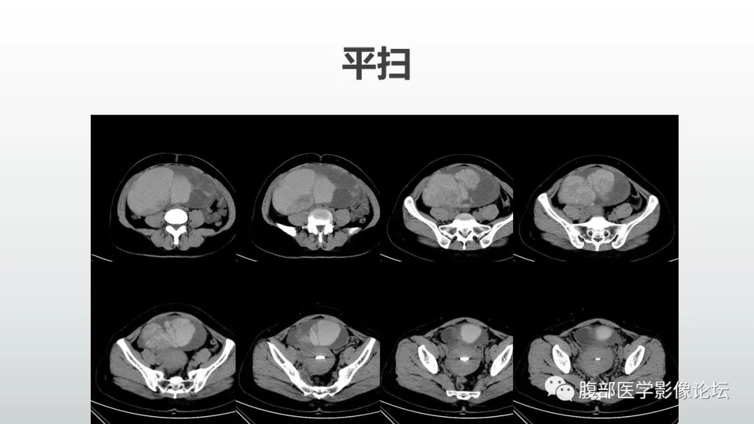 【病例】卵巢粘液性囊腺癌1例CT影像