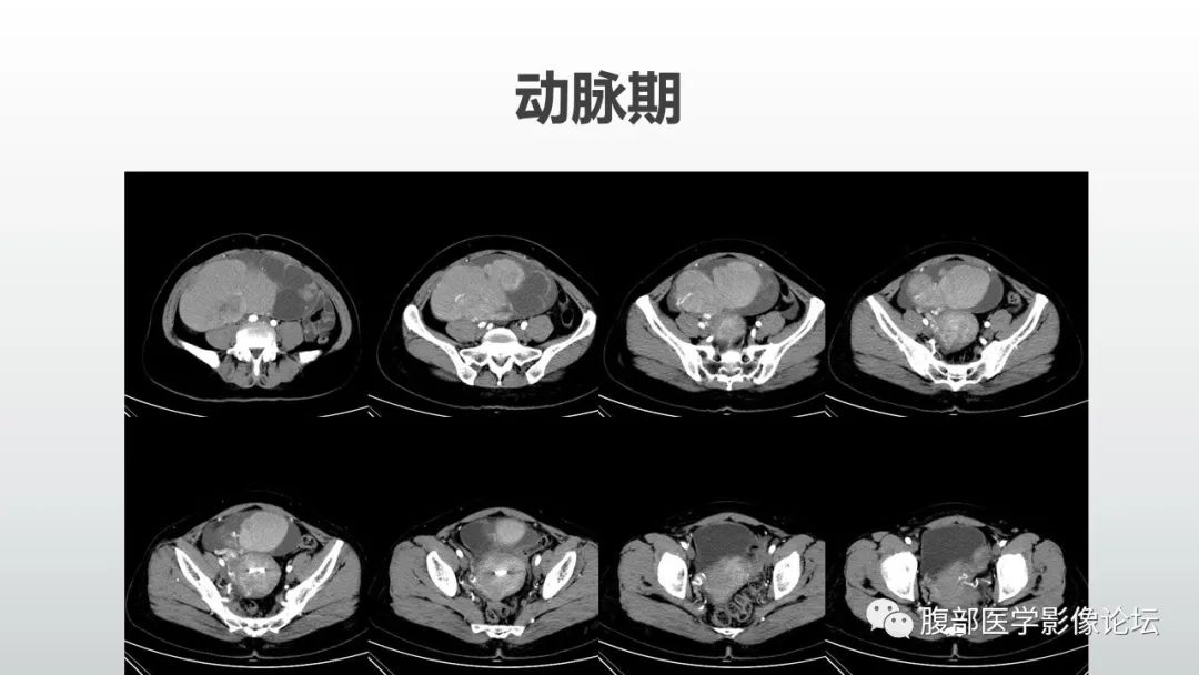 【病例】卵巢粘液性囊腺癌1例CT影像