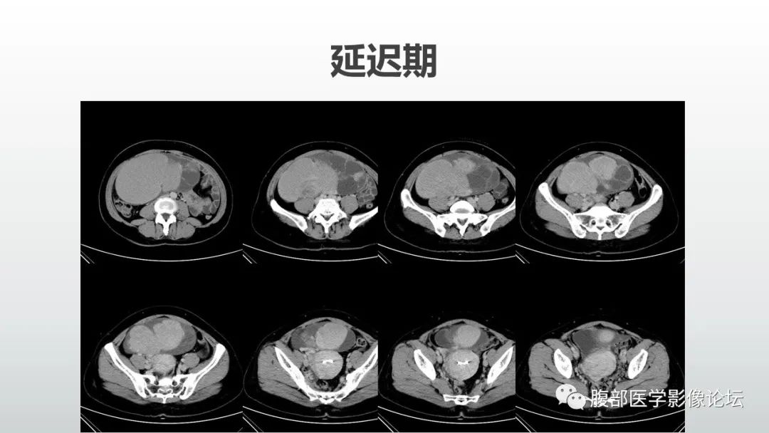 【病例】卵巢粘液性囊腺癌1例CT影像