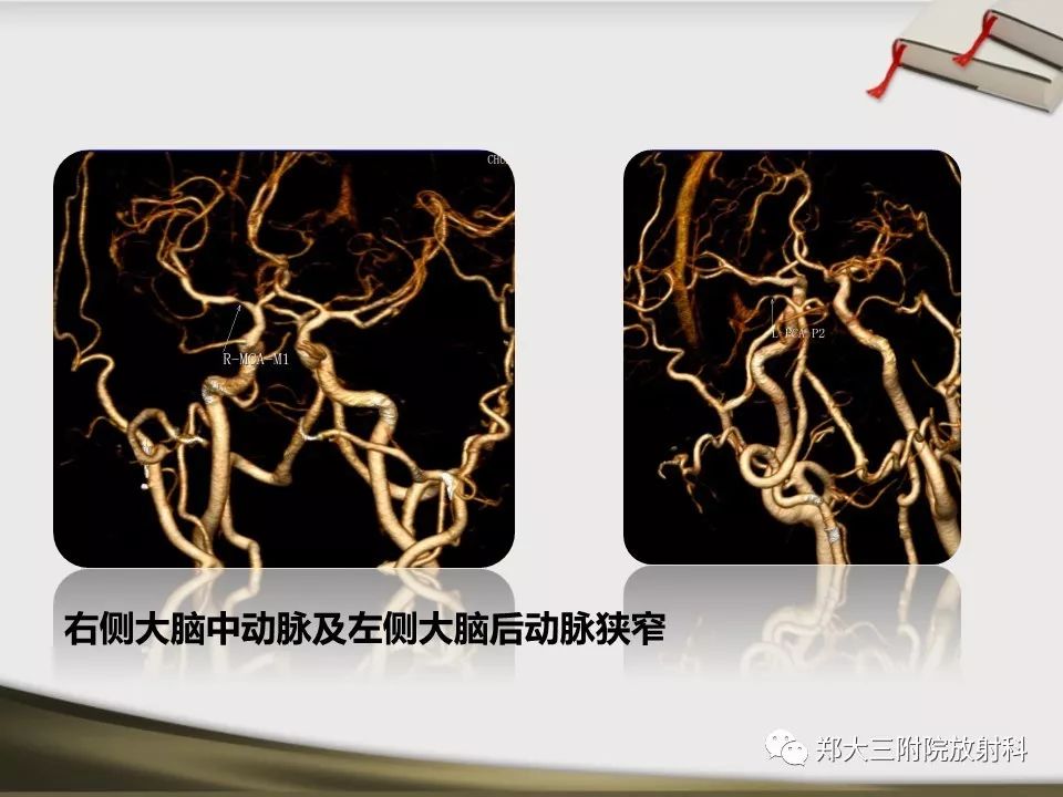 【PPT】头颈联合CTA临床应用