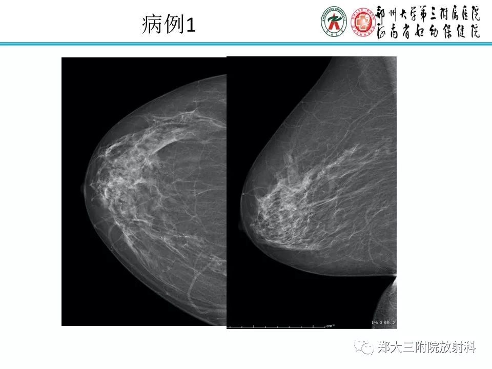 【PPT】乳腺导管内癌的X线表现