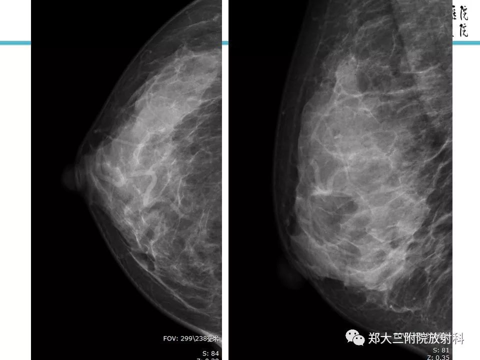 【PPT】乳腺导管内癌的X线表现