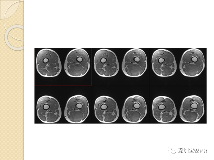 【病例】大腿粘液纤维肉瘤1例MR影像