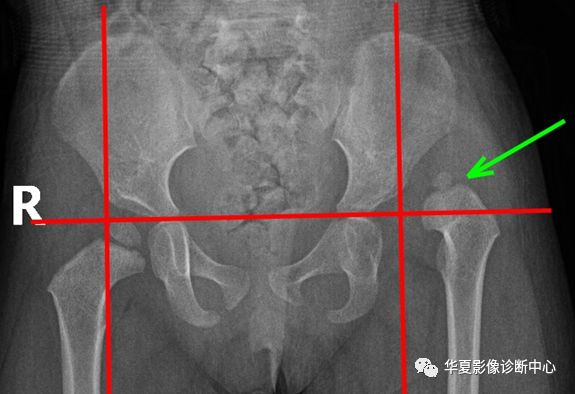 髋关节的X线测量