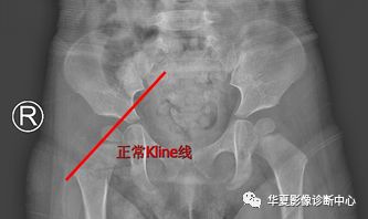 髋关节的X线测量