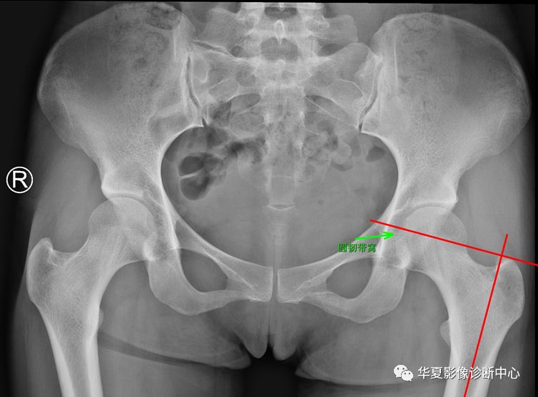髋关节的X线测量