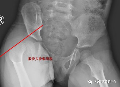 髋关节的X线测量