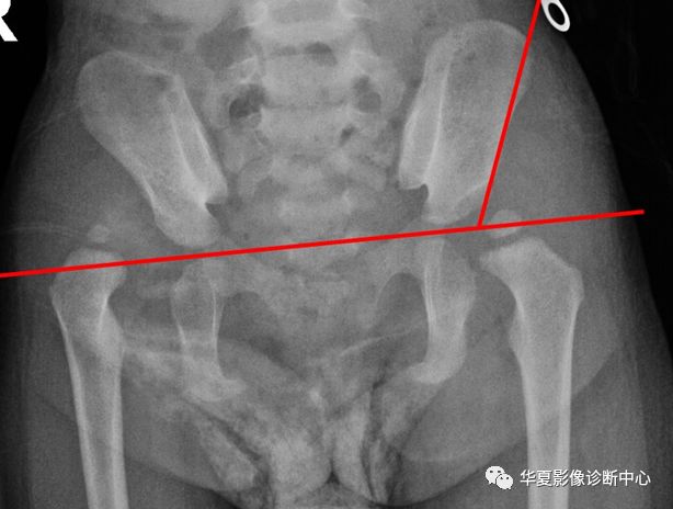 髋关节的X线测量