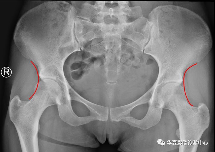 髋关节的X线测量
