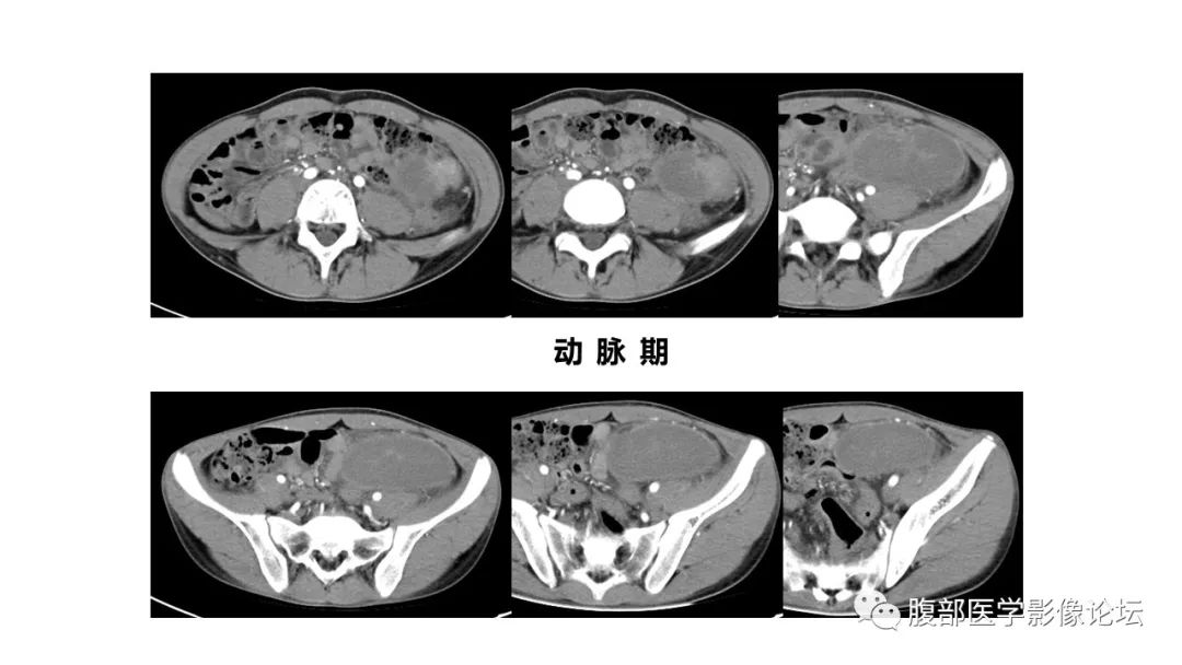 【病例】副脾伴梗死1里CT及MR影像