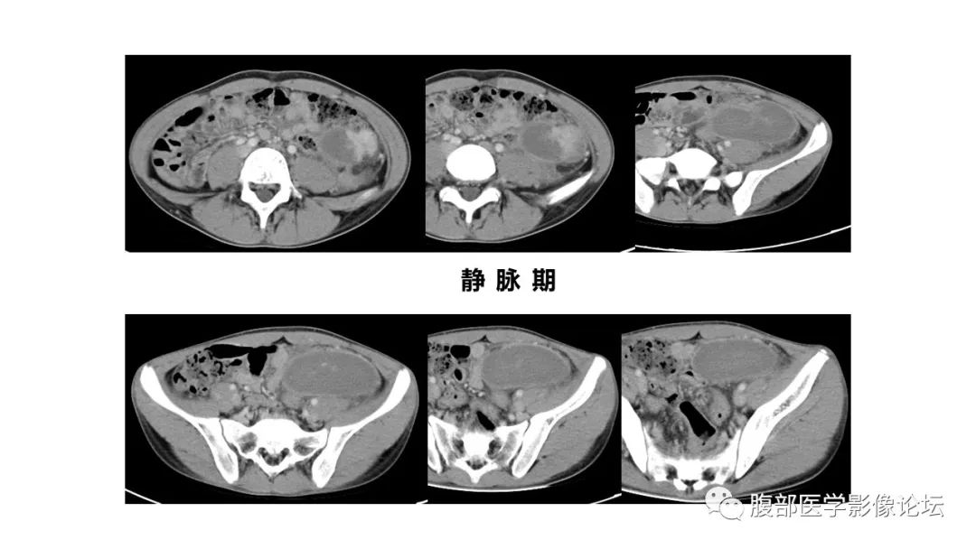 【病例】副脾伴梗死1里CT及MR影像
