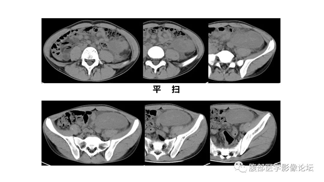 【病例】副脾伴梗死1里CT及MR影像