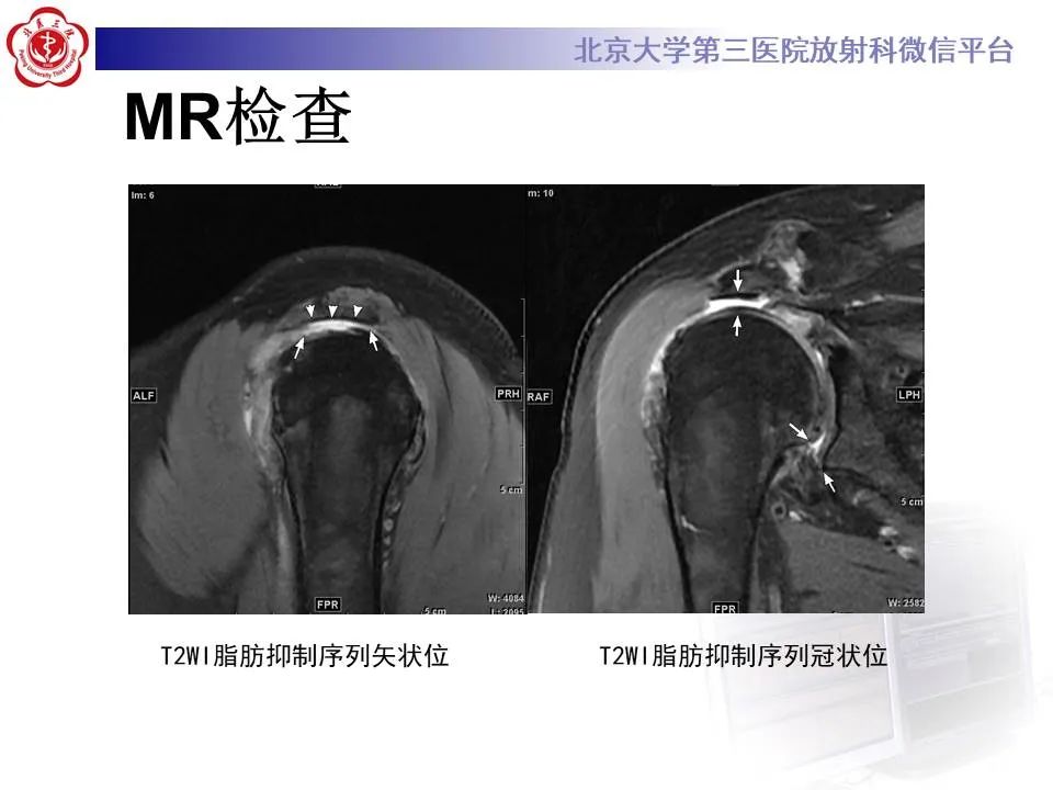 【PPT】慢性肩袖巨大撕裂的MR诊断