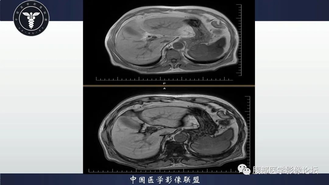 【病例】脾脏弥漫性大B细胞淋巴瘤1例MR影像讨论