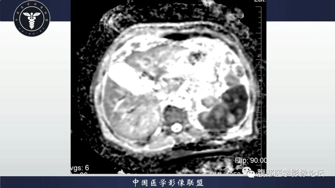 【病例】脾脏弥漫性大B细胞淋巴瘤1例MR影像讨论