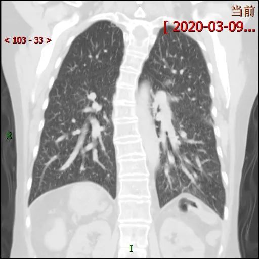 【病例】多脾综合征1例CT影像
