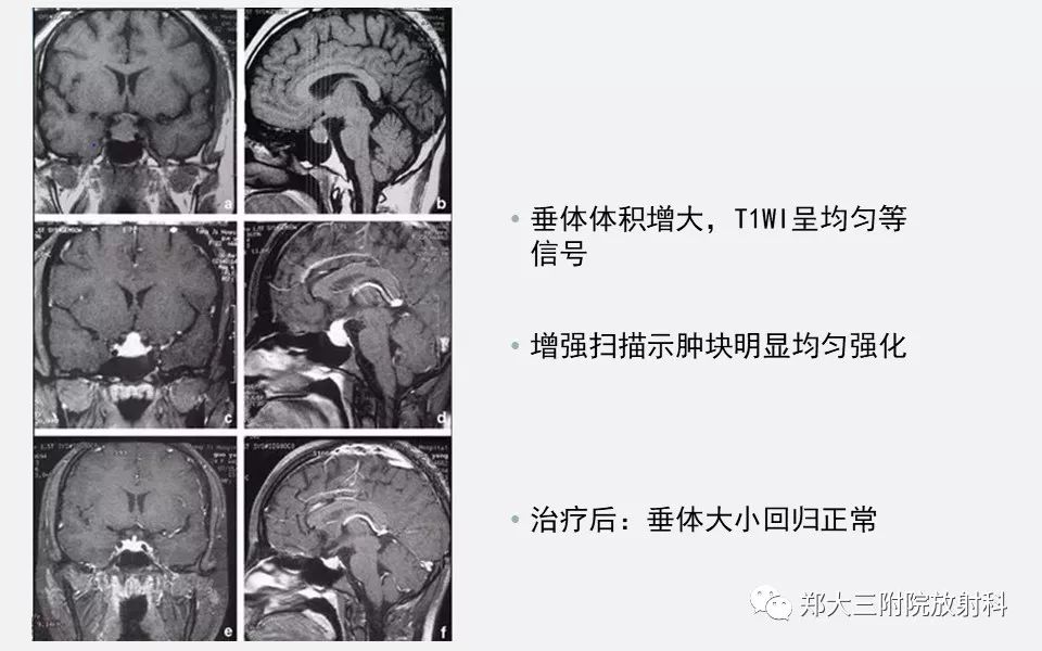 【PPT】垂体增生的影像表现 【PPT】垂体增生的影像表现