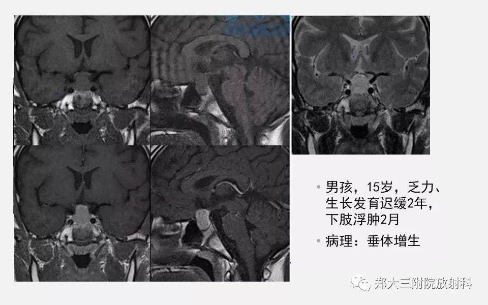 【PPT】垂体增生的影像表现 【PPT】垂体增生的影像表现
