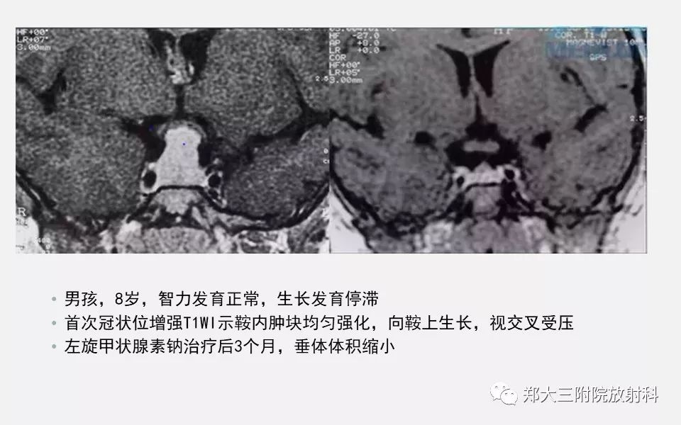 【PPT】垂体增生的影像表现 【PPT】垂体增生的影像表现