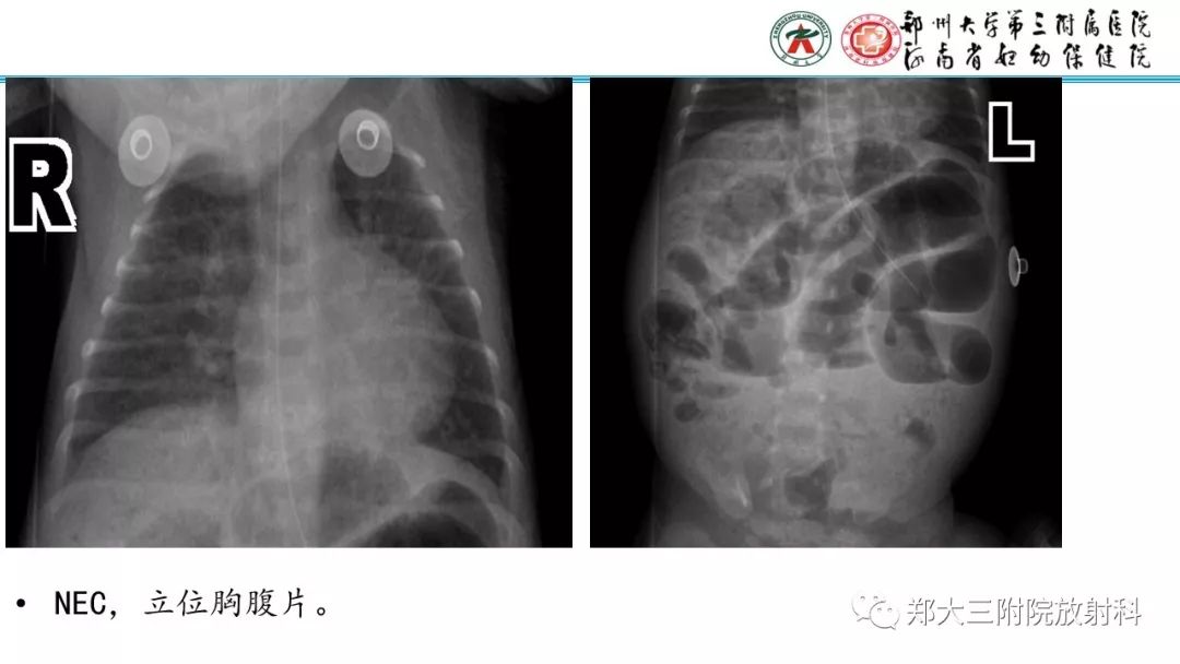 【PPT】新生儿床边胸片解读与置管评价
