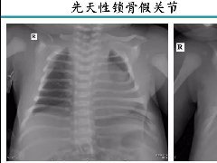 新生儿床边胸片解读与置管评价