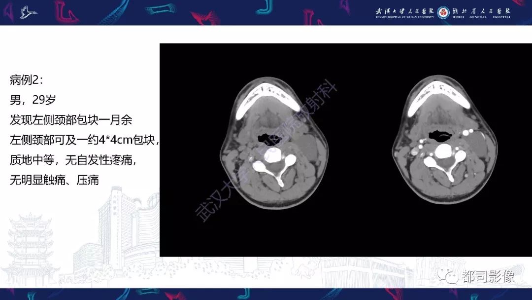 【PPT】咽旁间隙解剖及病变影像诊断 【PPT】咽旁间隙解剖及病变影像诊断