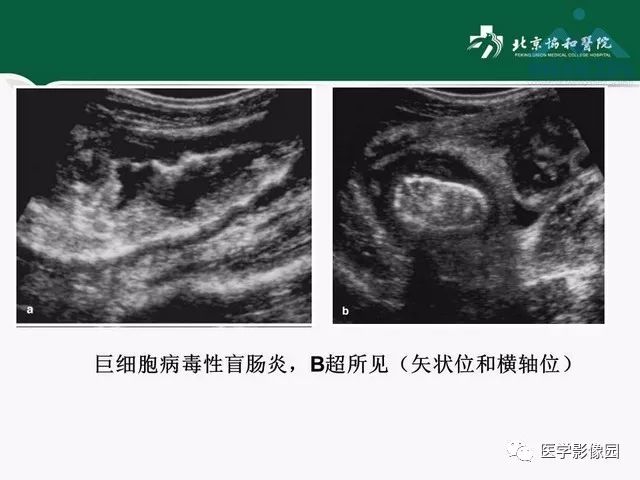 【PPT】艾滋病相关消化道影像学表现