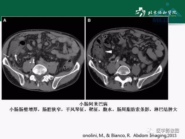 【PPT】艾滋病相关消化道影像学表现