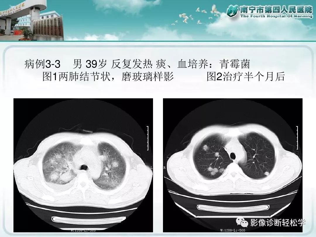 【PPT】艾滋病相关性胸部影像学表现