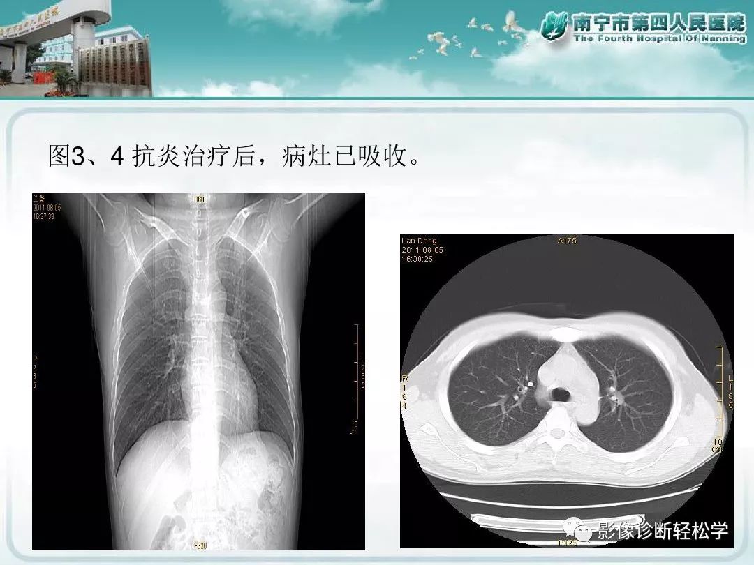 【PPT】艾滋病相关性胸部影像学表现