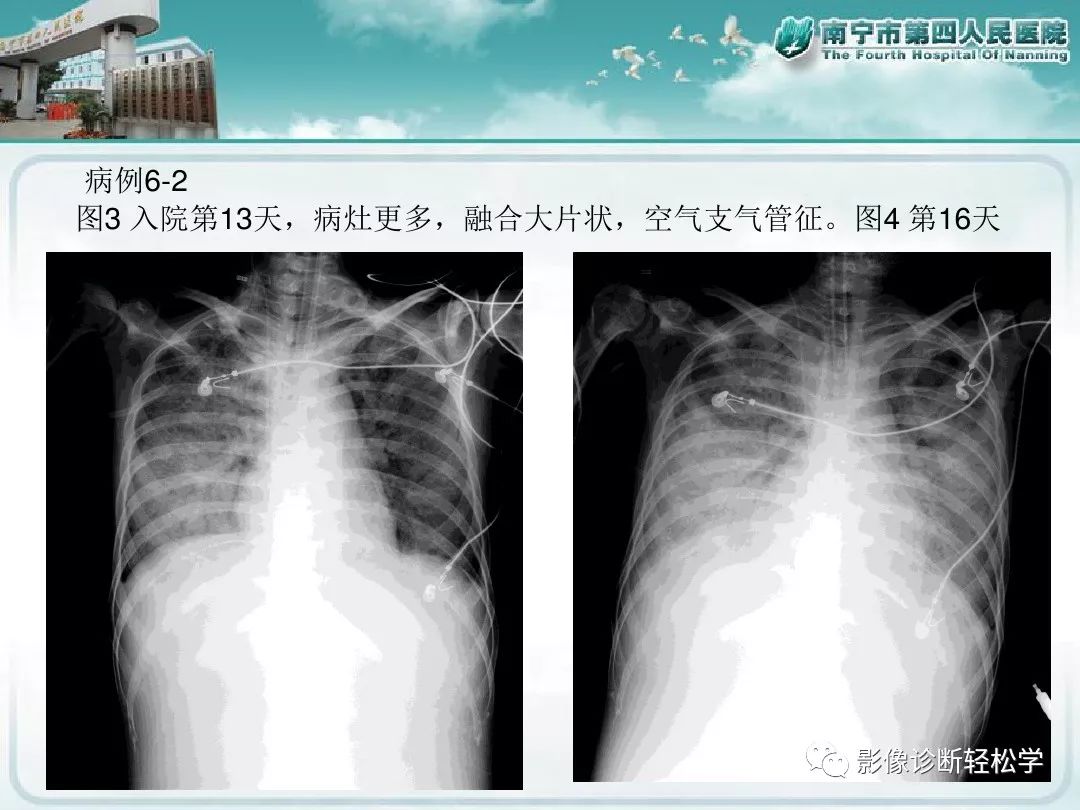 【PPT】艾滋病相关性胸部影像学表现