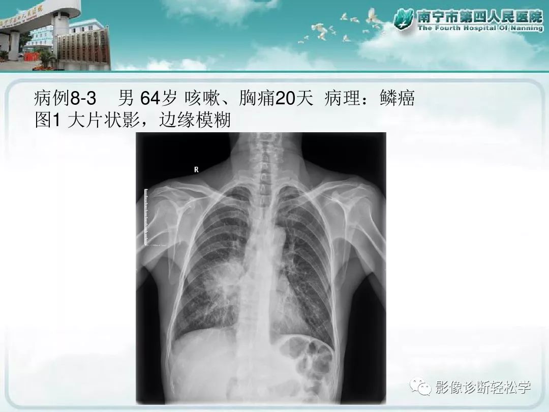【PPT】艾滋病相关性胸部影像学表现