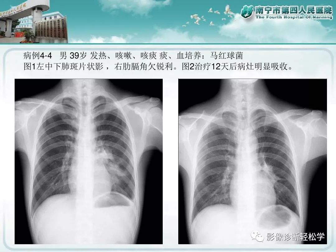 【PPT】艾滋病相关性胸部影像学表现