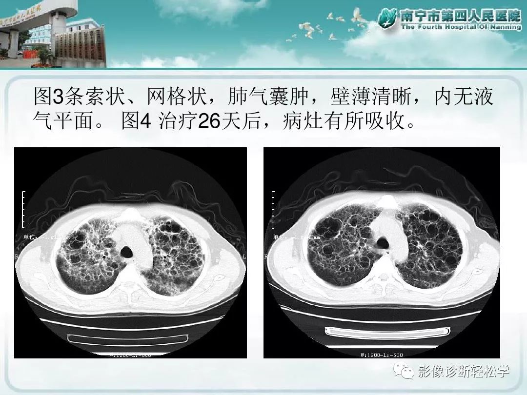 【PPT】艾滋病相关性胸部影像学表现