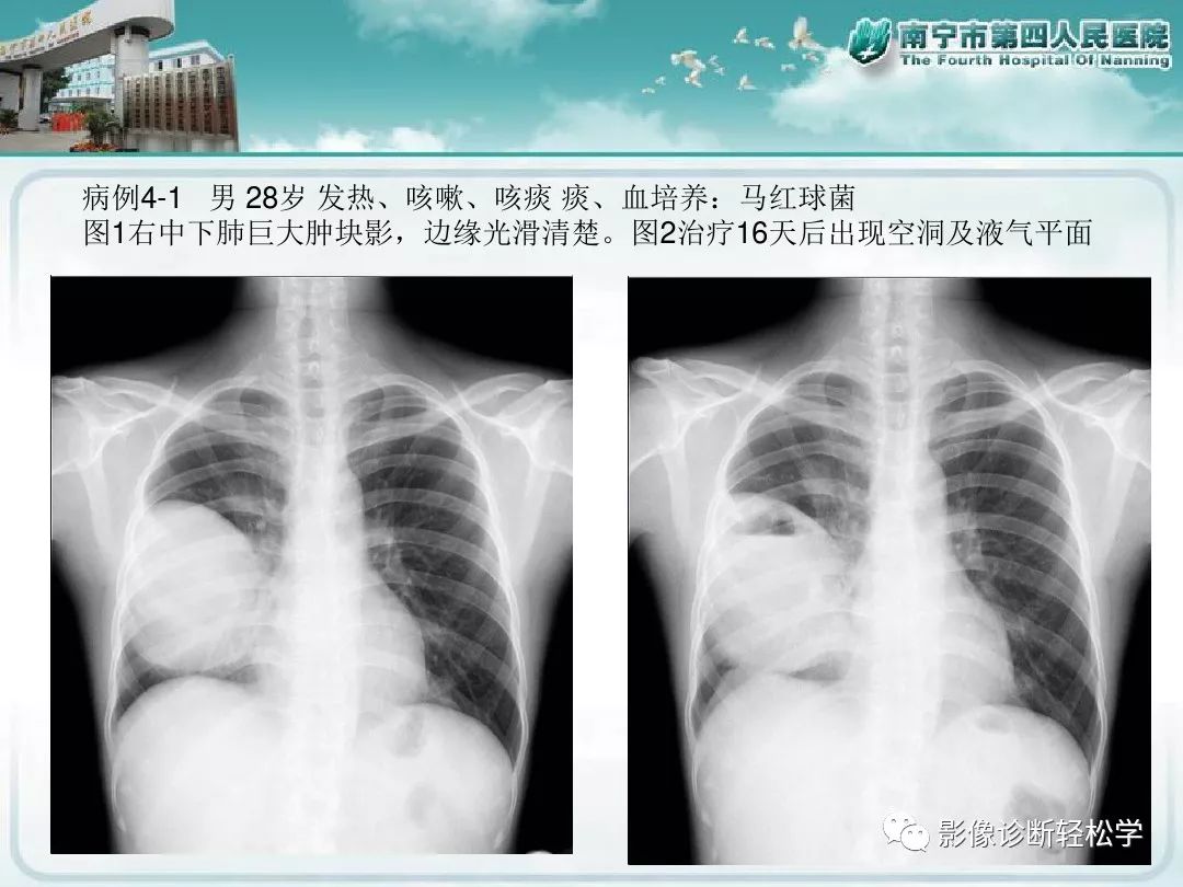 【PPT】艾滋病相关性胸部影像学表现