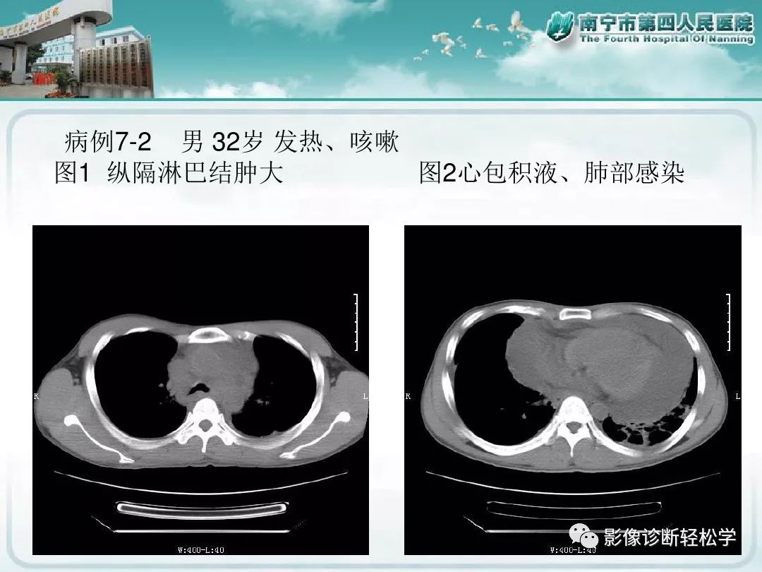 【PPT】艾滋病相关性胸部影像学表现