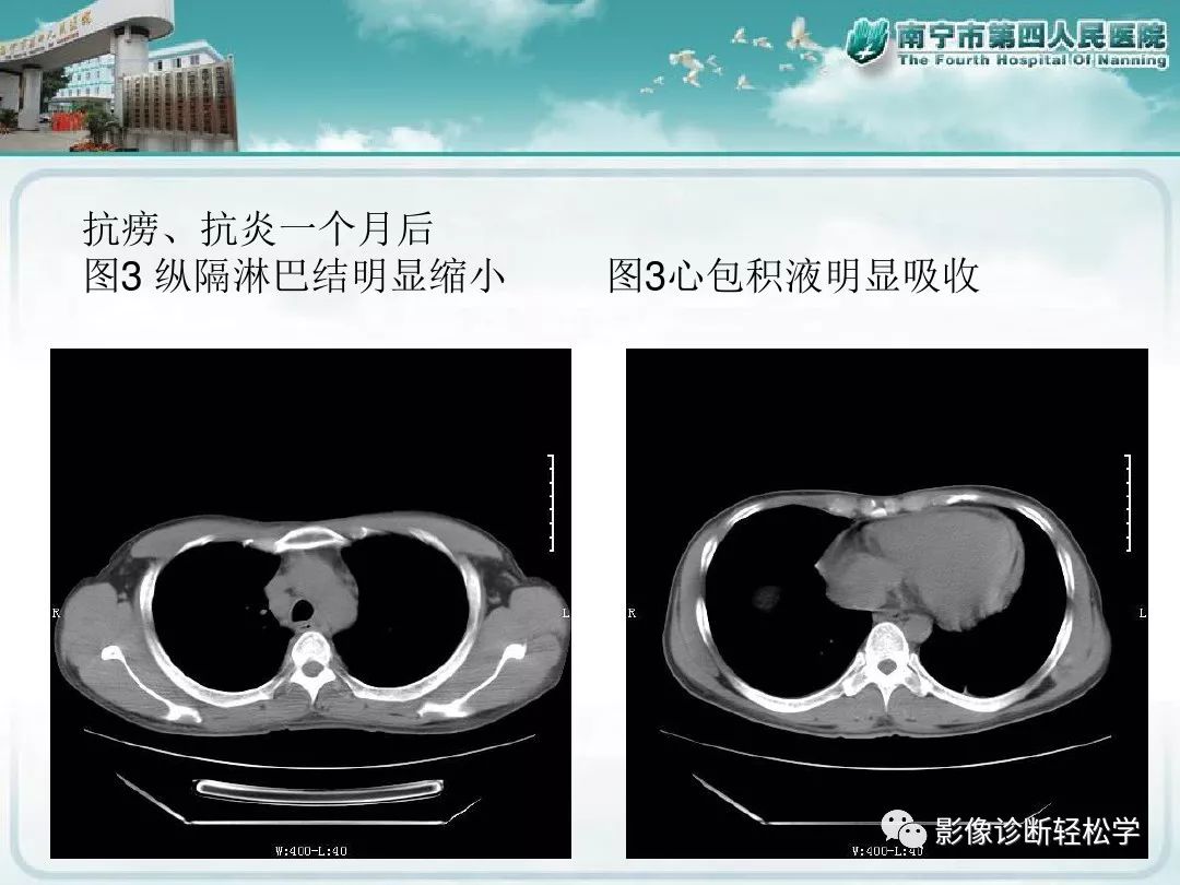 【PPT】艾滋病相关性胸部影像学表现