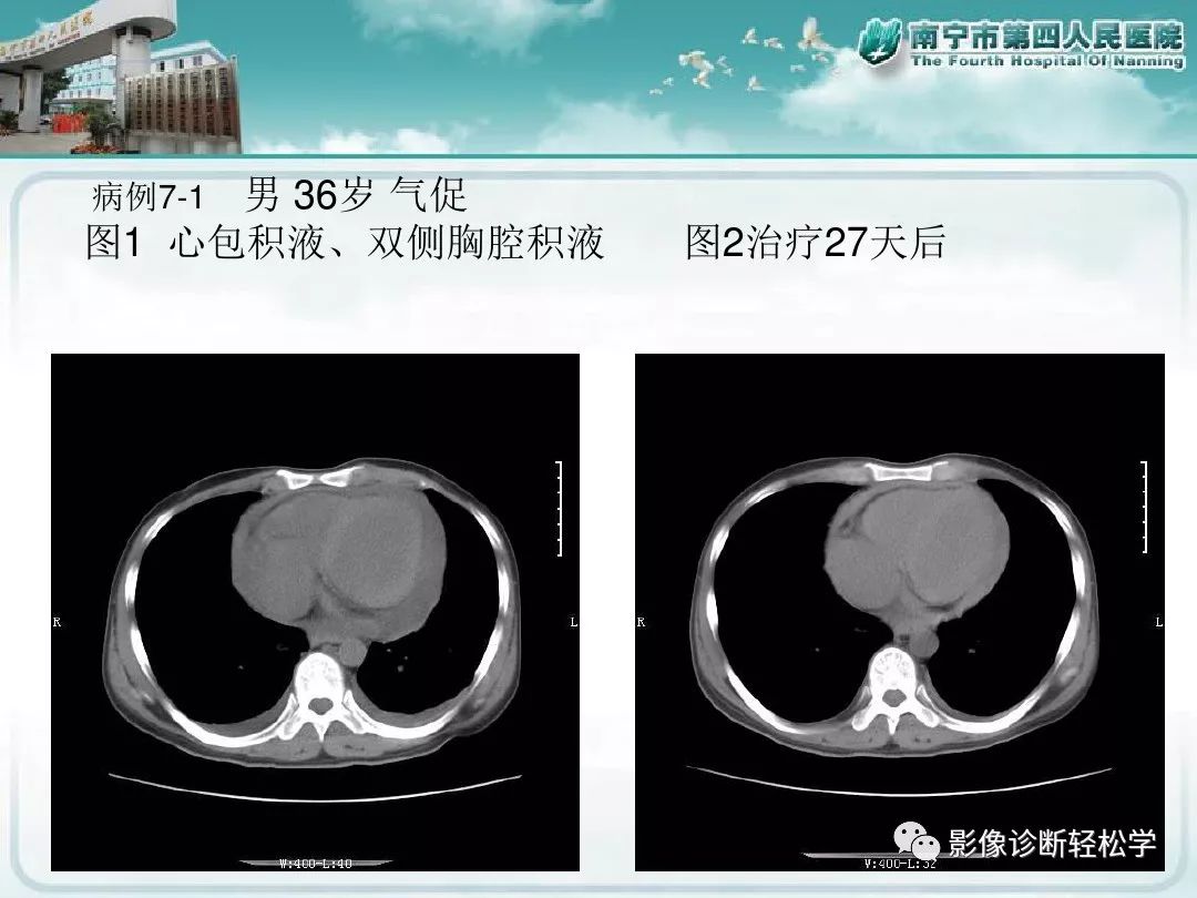 【PPT】艾滋病相关性胸部影像学表现