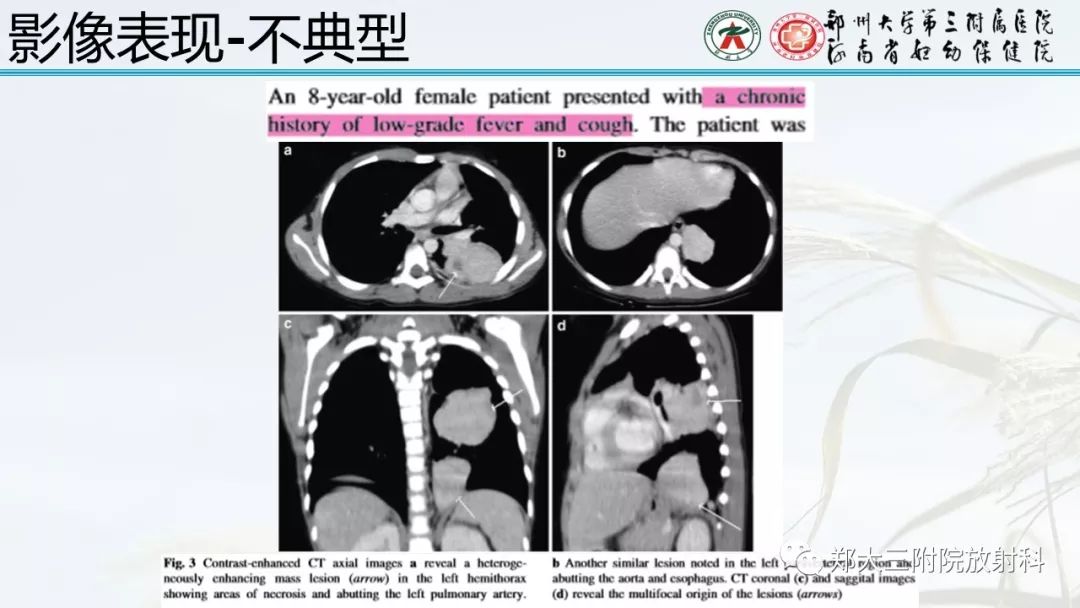 【PPT】炎性肌纤维母细胞瘤的影像表现 【PPT】炎性肌纤维母细胞瘤的影像表现