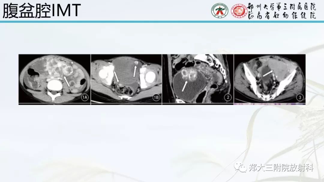 【PPT】炎性肌纤维母细胞瘤的影像表现 【PPT】炎性肌纤维母细胞瘤的影像表现